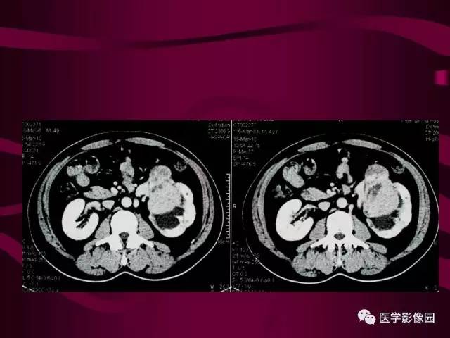 【病例】肾脏恶性纤维组织细胞瘤1例CT影像表现 【病例】肾脏恶性纤维组织细胞瘤1例CT影像表现