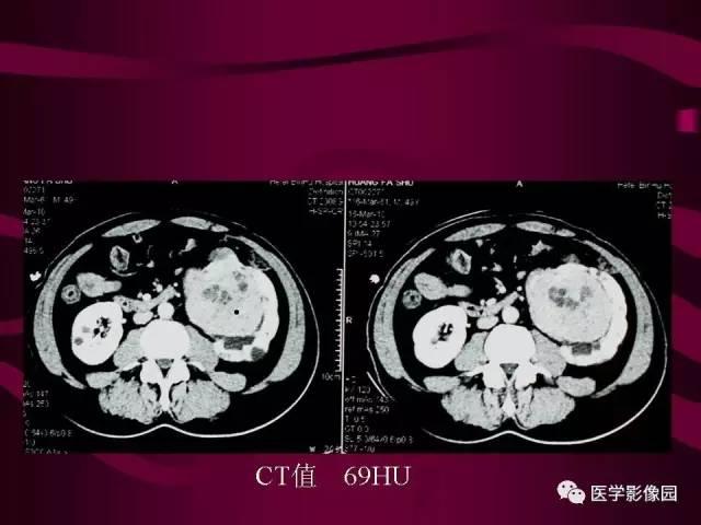 【病例】肾脏恶性纤维组织细胞瘤1例CT影像表现 【病例】肾脏恶性纤维组织细胞瘤1例CT影像表现