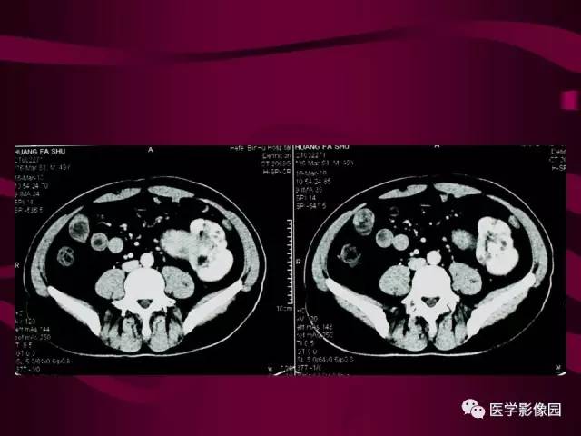 【病例】肾脏恶性纤维组织细胞瘤1例CT影像表现 【病例】肾脏恶性纤维组织细胞瘤1例CT影像表现