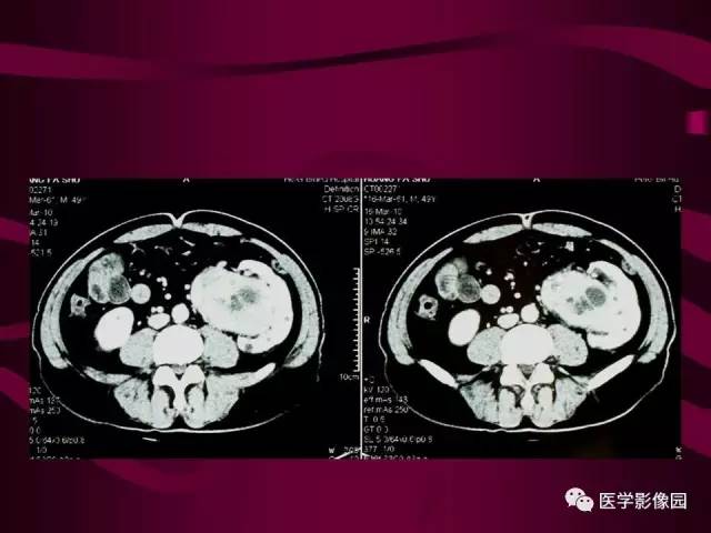 【病例】肾脏恶性纤维组织细胞瘤1例CT影像表现 【病例】肾脏恶性纤维组织细胞瘤1例CT影像表现