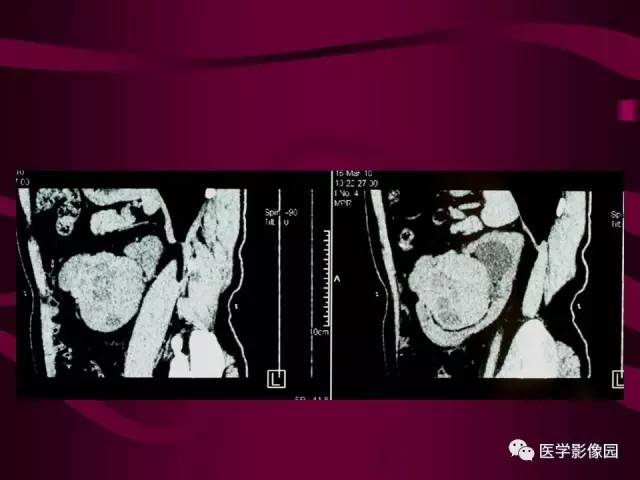 【病例】肾脏恶性纤维组织细胞瘤1例CT影像表现 【病例】肾脏恶性纤维组织细胞瘤1例CT影像表现