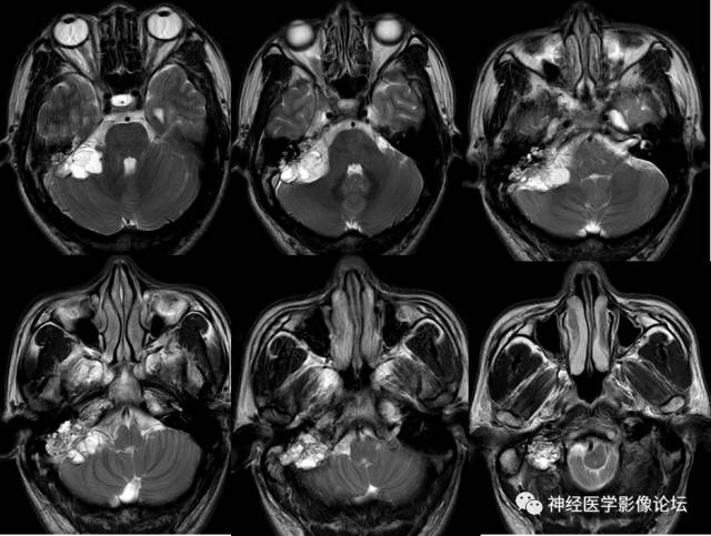 【病例】内淋巴囊瘤1例CT及MR影像表现