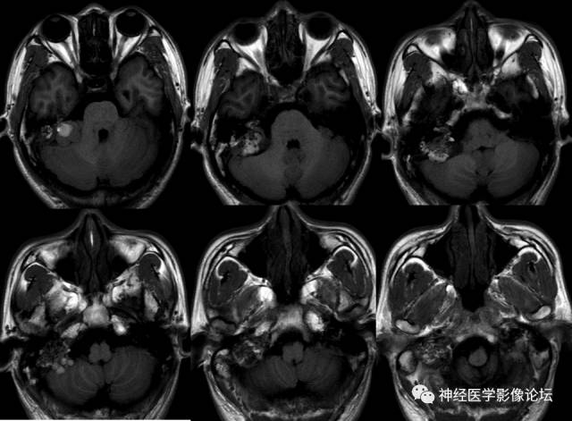 【病例】内淋巴囊瘤1例CT及MR影像表现