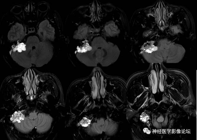 【病例】内淋巴囊瘤1例CT及MR影像表现