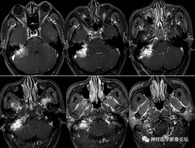 【病例】内淋巴囊瘤1例CT及MR影像表现