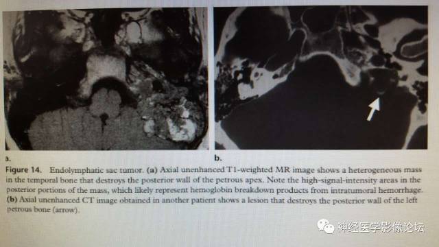 【病例】内淋巴囊瘤1例CT及MR影像表现