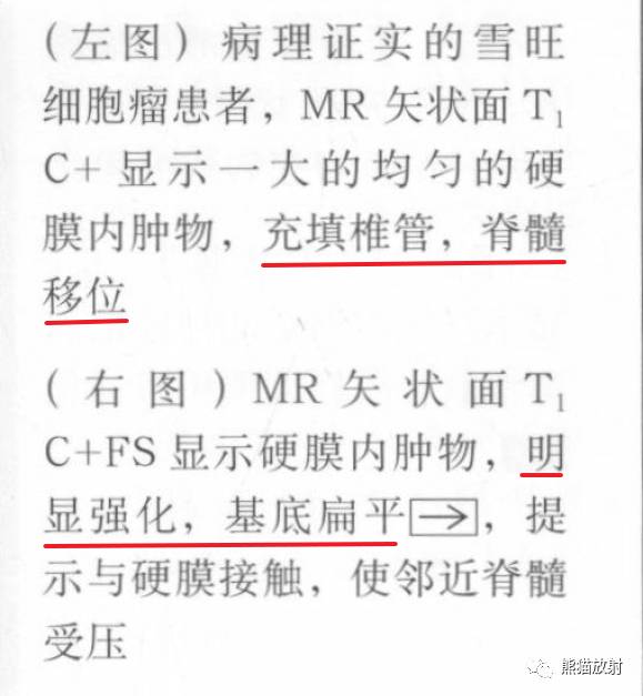 【书摘】“实性强化的硬膜内髓外病变”的鉴别诊断 【书摘】“实性强化的硬膜内髓外病变”的鉴别诊断