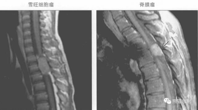 【书摘】“实性强化的硬膜内髓外病变”的鉴别诊断