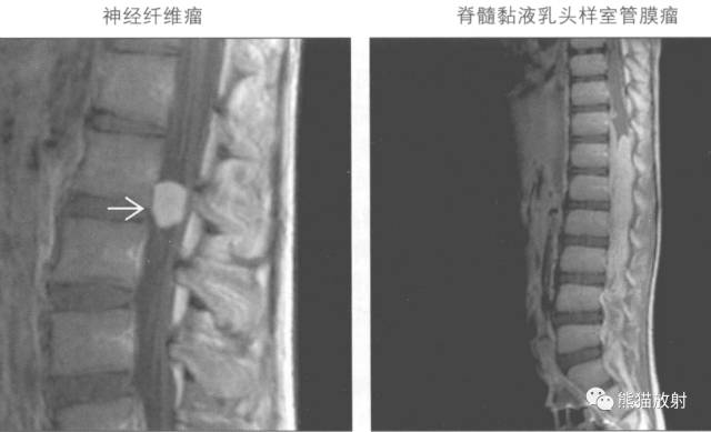 【书摘】“实性强化的硬膜内髓外病变”的鉴别诊断 【书摘】“实性强化的硬膜内髓外病变”的鉴别诊断