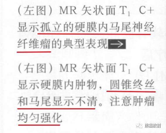 【书摘】“实性强化的硬膜内髓外病变”的鉴别诊断 【书摘】“实性强化的硬膜内髓外病变”的鉴别诊断