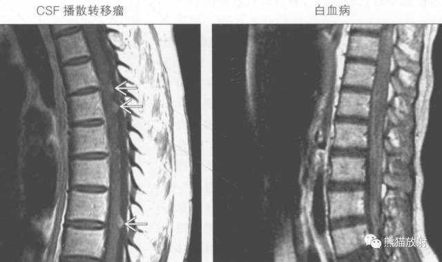 【书摘】“实性强化的硬膜内髓外病变”的鉴别诊断 【书摘】“实性强化的硬膜内髓外病变”的鉴别诊断