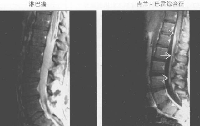 【书摘】“实性强化的硬膜内髓外病变”的鉴别诊断 【书摘】“实性强化的硬膜内髓外病变”的鉴别诊断