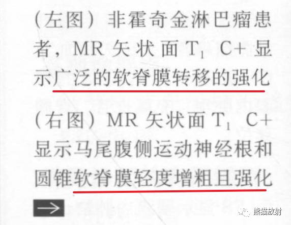 【书摘】“实性强化的硬膜内髓外病变”的鉴别诊断 【书摘】“实性强化的硬膜内髓外病变”的鉴别诊断