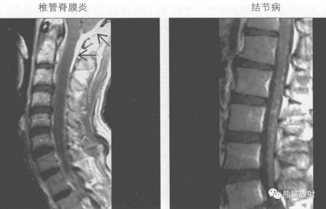 【书摘】“实性强化的硬膜内髓外病变”的鉴别诊断 【书摘】“实性强化的硬膜内髓外病变”的鉴别诊断