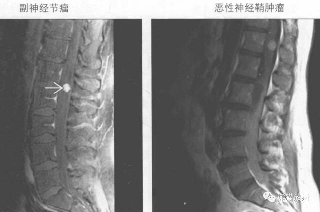 【书摘】“实性强化的硬膜内髓外病变”的鉴别诊断 【书摘】“实性强化的硬膜内髓外病变”的鉴别诊断
