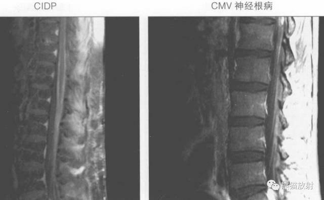 【书摘】“实性强化的硬膜内髓外病变”的鉴别诊断 【书摘】“实性强化的硬膜内髓外病变”的鉴别诊断