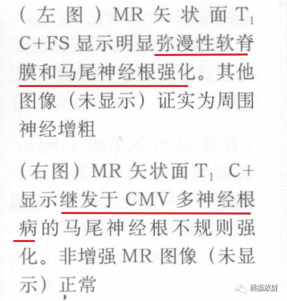 【书摘】“实性强化的硬膜内髓外病变”的鉴别诊断 【书摘】“实性强化的硬膜内髓外病变”的鉴别诊断