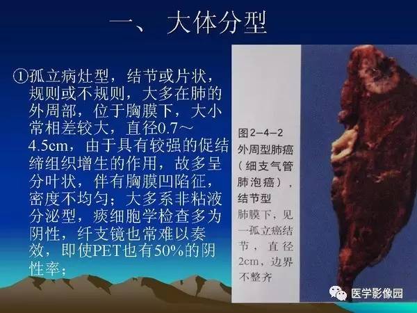 【PPT】细支气管肺泡癌的影像诊断