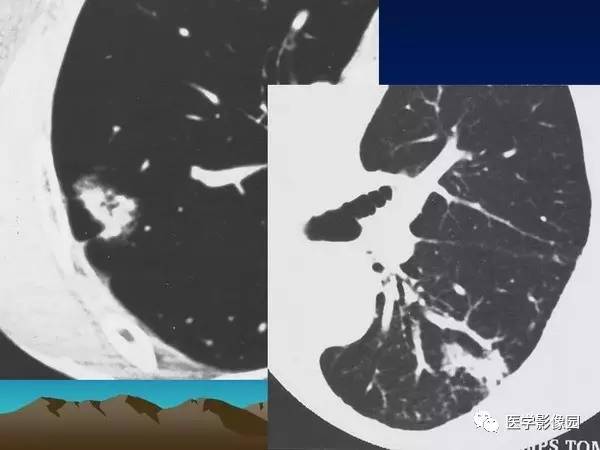 【PPT】细支气管肺泡癌的影像诊断