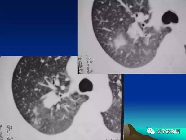 【PPT】细支气管肺泡癌的影像诊断