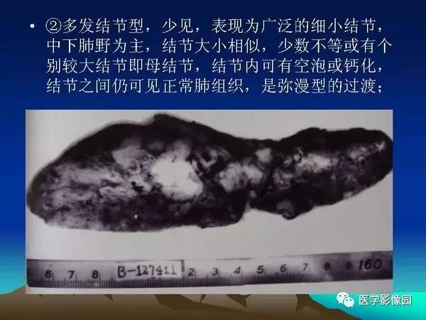 【PPT】细支气管肺泡癌的影像诊断