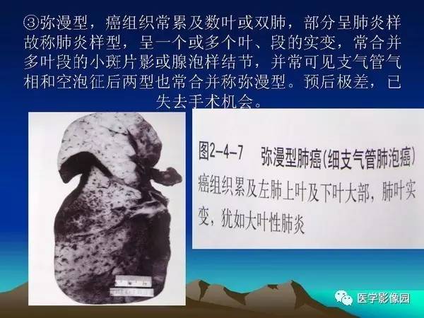 【PPT】细支气管肺泡癌的影像诊断