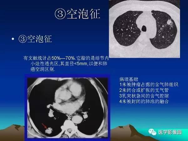 【PPT】细支气管肺泡癌的影像诊断