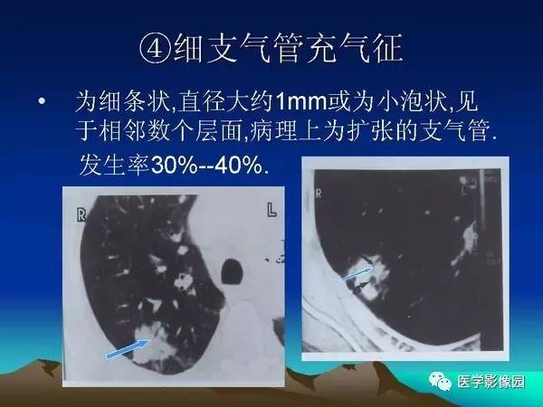 【PPT】细支气管肺泡癌的影像诊断