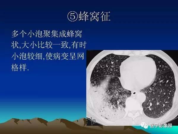 【PPT】细支气管肺泡癌的影像诊断