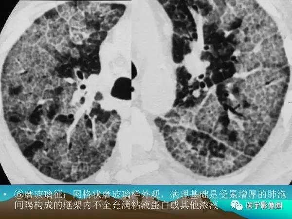 【PPT】细支气管肺泡癌的影像诊断