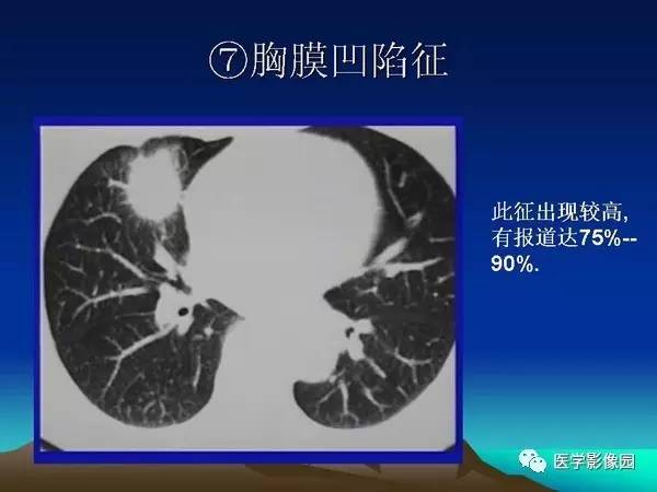 【PPT】细支气管肺泡癌的影像诊断