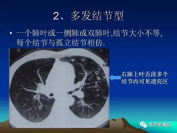 【PPT】细支气管肺泡癌的影像诊断