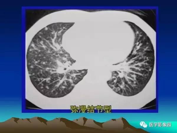 【PPT】细支气管肺泡癌的影像诊断