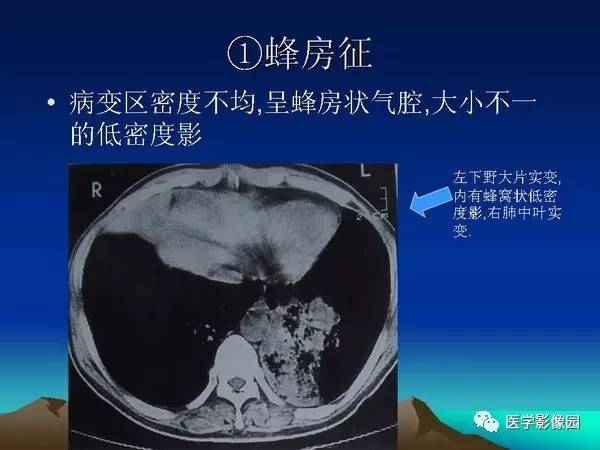 【PPT】细支气管肺泡癌的影像诊断