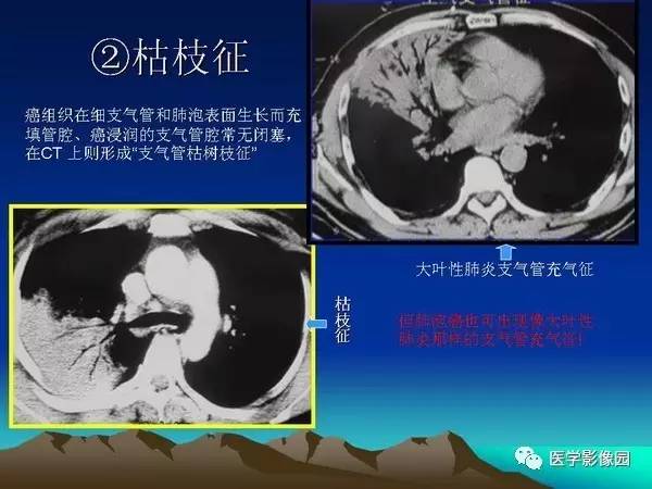 【PPT】细支气管肺泡癌的影像诊断