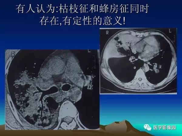 【PPT】细支气管肺泡癌的影像诊断