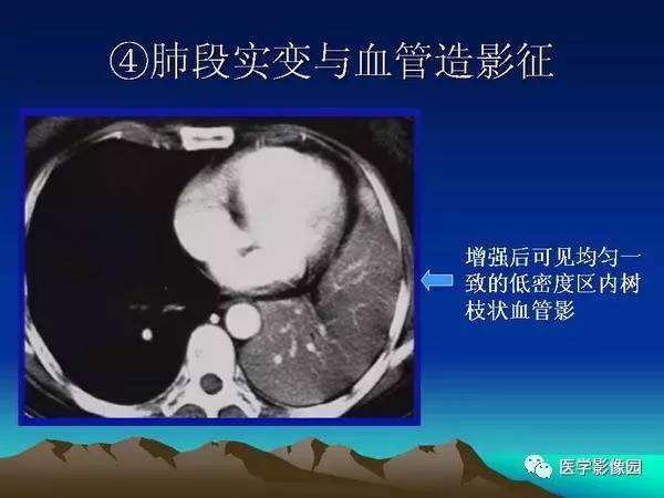 【PPT】细支气管肺泡癌的影像诊断