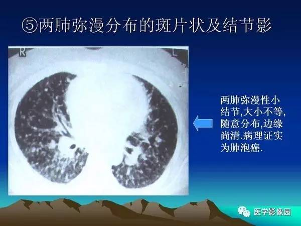 【PPT】细支气管肺泡癌的影像诊断