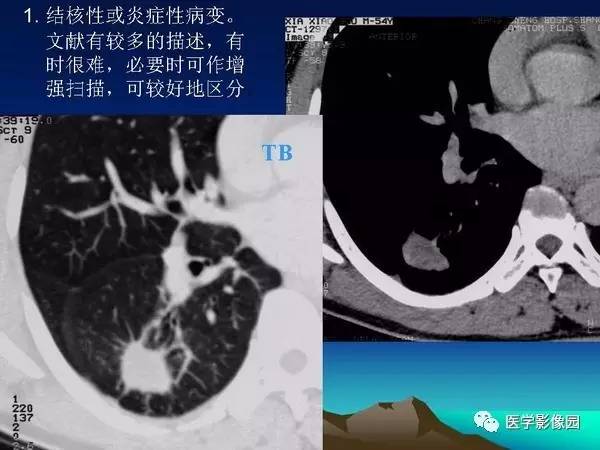 【PPT】细支气管肺泡癌的影像诊断