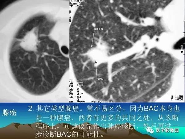 【PPT】细支气管肺泡癌的影像诊断