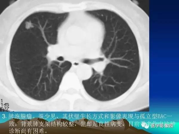 【PPT】细支气管肺泡癌的影像诊断