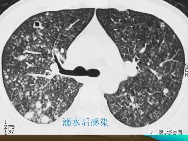 【PPT】细支气管肺泡癌的影像诊断