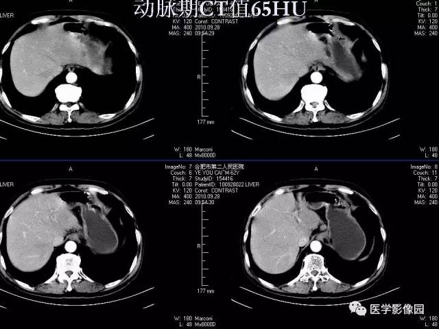 【病例】肝脏结核1例CT影像表现