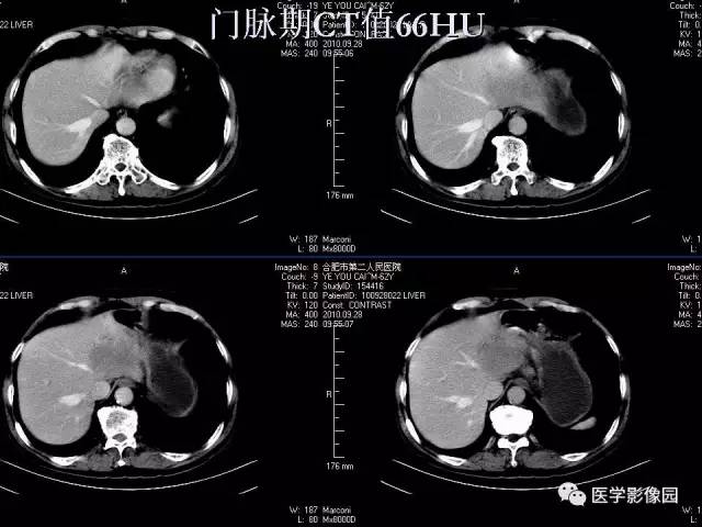 【病例】肝脏结核1例CT影像表现
