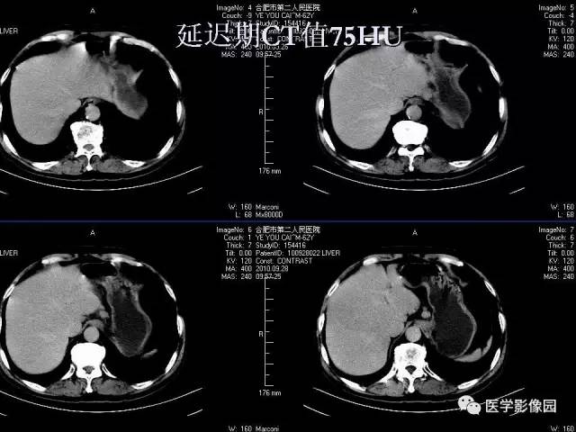 【病例】肝脏结核1例CT影像表现