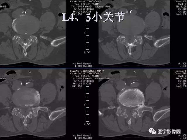 【病例】肝脏结核1例CT影像表现