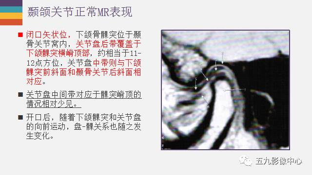 【PPT】颞颌关节病变的MR诊断