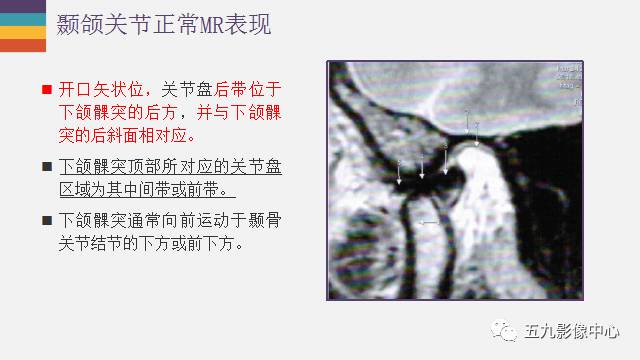 【PPT】颞颌关节病变的MR诊断