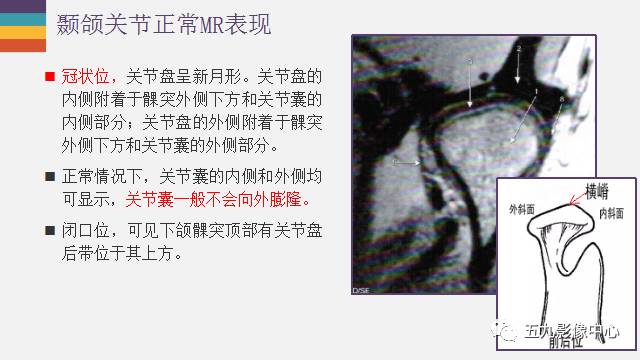 【PPT】颞颌关节病变的MR诊断