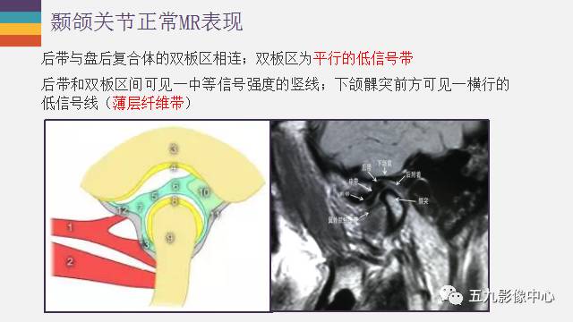 【PPT】颞颌关节病变的MR诊断